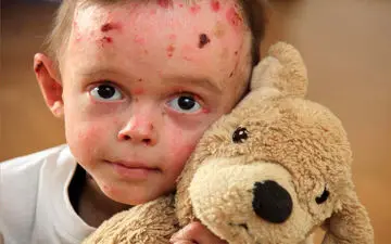 انواع پوست پروانه ای