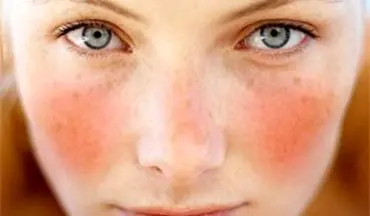  سرخ شدن صورت| علت و نشانه‌های سرخ شدن صورت چیست؟