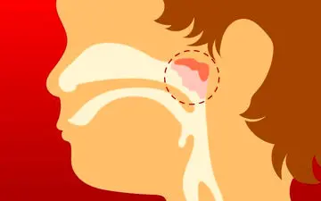 چرا باید لوزه سوم را جراحی کنیم؟