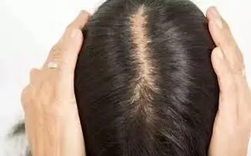 غذاهایی که ریزش مو را در زنان بدتر می‌کند!