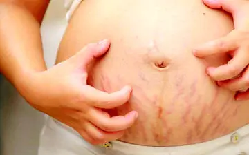 درمان ترک روی شکم با سفیده‌ی تخم مرغ