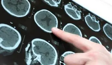 نسخه‌ای شفابخش برای درمان سکته‌های مغزی