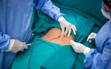 راهنمای کامل مراقبت‌های بعد از لیپوساکشن: چه باید کرد و چه نباید کرد؟!