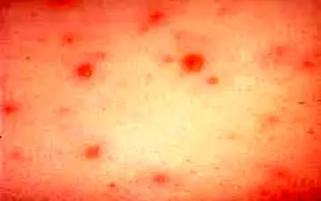 واکسن آبله‌مرغان به چه افرادی توصیه می‌شود؟