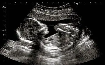 سقط جنین به خاطر دخالت و تهمت‌های مادرشوهر
