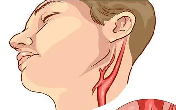 علائم بیماری گرفتگی عروق مغز