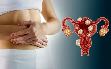 افزایش احتمال ناباروری در مبتلایان آندومتریوز
