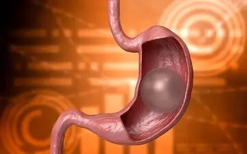 این بالن می تواند از «چاق شدن» جلوگیری کند

