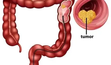  سرطان روده بزرگ در جوانان نگران کننده شده است!| مراقب باشید!