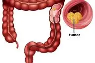  سرطان روده بزرگ در جوانان نگران کننده شده است!| مراقب باشید!