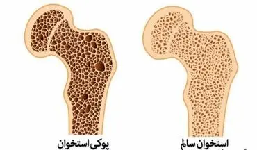 پوکی استخوان و سارکوپنی دو بیماری خاموش سنین بالای ۵۰ سال