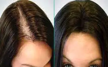 صفرتا صد کاشت مو|هر آن چه که باید از کاشت مو بدانید