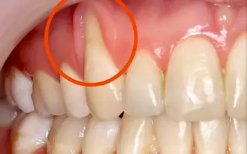 علت عقب‌رفتگی لثه چیست؟