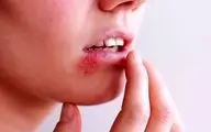 تبخال دهانی چقدر خطرناک است؟ یافته‌های جدید و نگران‌کننده دانشمندان 