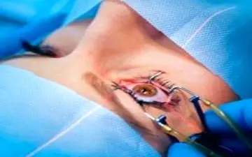 بینایی پس از جراحی آب مروارید باز می گردد؟