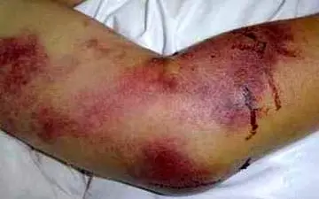 وضعیت تب کریمه کنگو در یزد چگونه است؟! 