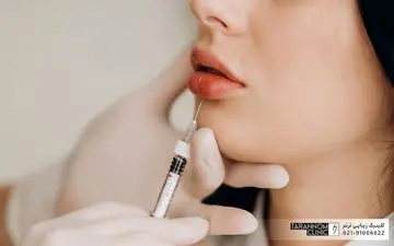 مراقبت های بعد از تزریق ژل لب چیست؟