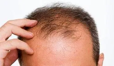 داروهای ضد ریزش مو خطر ناتوانی جنسی را افزایش می دهند
