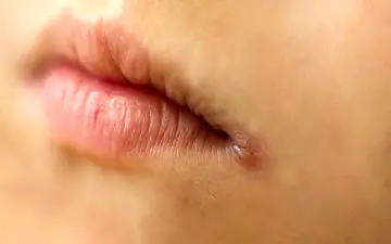 علت زخم‌های ایجادشده در گوشه‌های دهان چیست؟