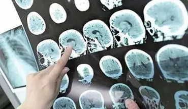 مشاهده فعالیت مغزی تا ۱۰ دقیقه پس از مرگ!