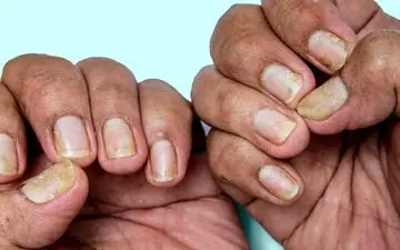 از سندرم ناخن زرد چه می دانید؟