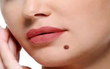  ۴ نشانه خال‌های خطرناک