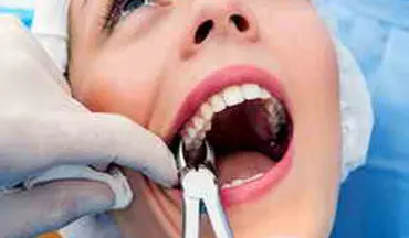 کشیدن دندان عقل آیا لازم است؟