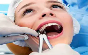 کشیدن دندان عقل آیا لازم است؟