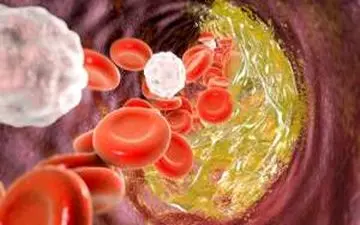 این موارد علائم کلسترول بالا هستند!