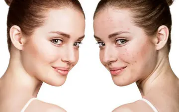 چگونه جای جوش را از بین ببریم؟