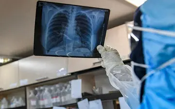 کاهش نفس تنگی بعد بهبود کرونا با این روش ها