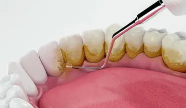  جرم‌گیری به دندان آسیب می زند؟