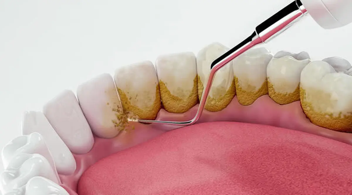  جرم‌گیری به دندان آسیب می زند؟