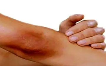 راهکاری برای درمان تیرگی آرنج و زانو