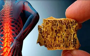  پوکی استخوان و علائم پنهان آن

