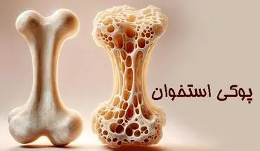 زنان بیش از مردان در معرض ابتلا به پوکی استخوان هستند