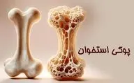زنان بیش از مردان در معرض ابتلا به پوکی استخوان هستند