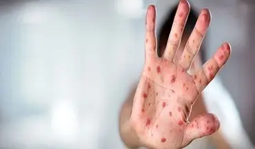 واکسیناسیون، سپر اصلی در برابر تهدید سرخک