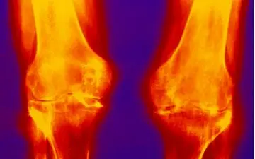 مهم ترین علل ایجاد عارضه زانوی پرانتزی