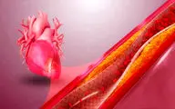 سکته قلبی خاموش چیست؟