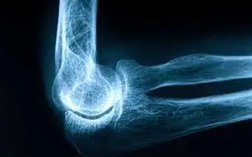 هوشیار باشید/این بیماری بی سر و صدا سراغتان می آید