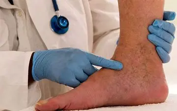  درمان واریس با گوجه فرنگی