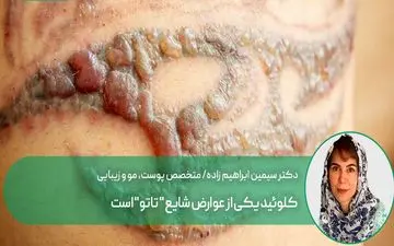 کلوئید، شایع ترین عوارض تاتو