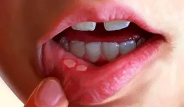 آفت دهانی بدلیل کمبود یک ویتامین