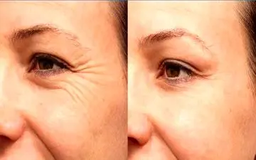 برای از بین بردن چین و چروک پوست چه کنیم