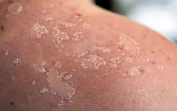 علائم سرطان پوست  را بشناسید!