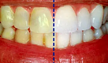 جرم گیری دندان با پوست گردو در 5 دقیقه