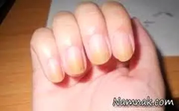 تغییر رنگ ناخن‌ها را جدی بگیرید