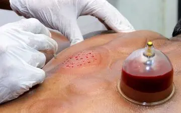 حجامت می‌تواند جایگزین واکسن کرونا باشد؟