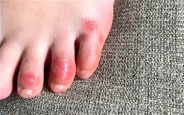 بروز "لکه‌" روی انگشتان می‌تواند نشانه ابتلا به کرونا باشد!